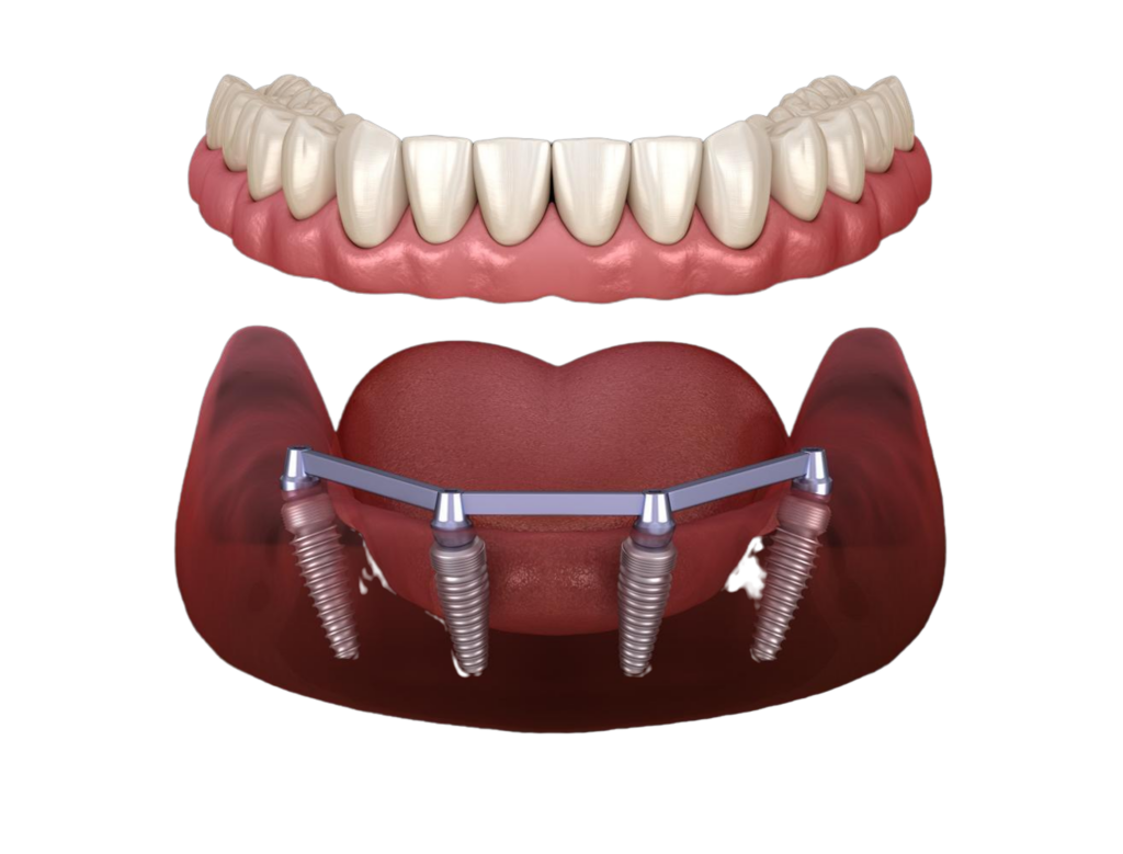 Full-Mouth Dental Implants - Smile 3D